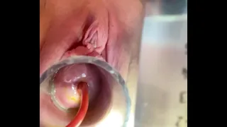 Cries from as catheter balloon expands