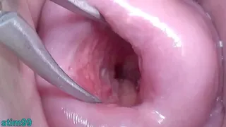 Uncensored Asian Milf Cervix Stretched Open Wide to watch inside the expandided Uterus