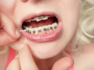 Braces Debut: Rough Dental Flossing